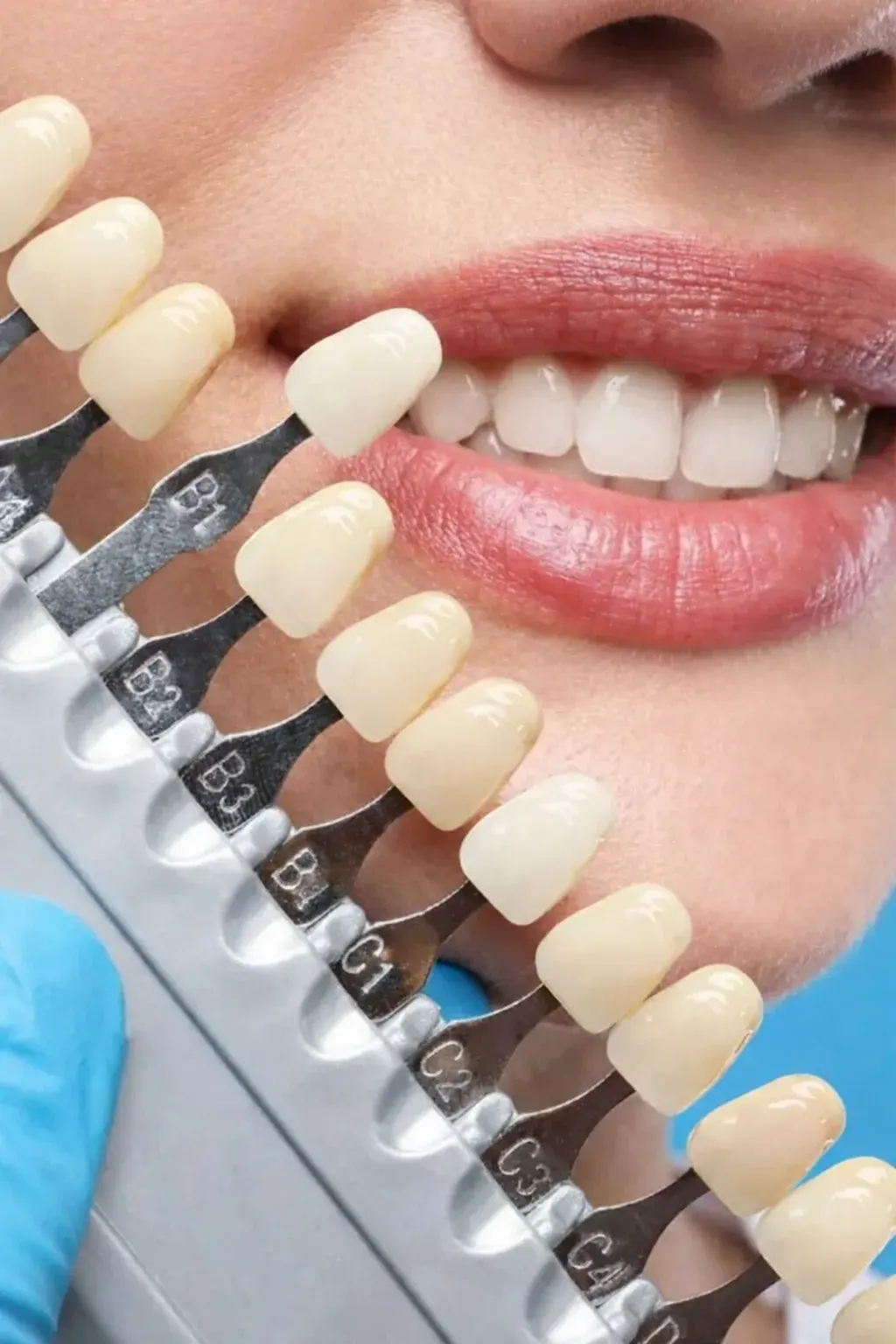 Sbiancamento dentale personalizzato