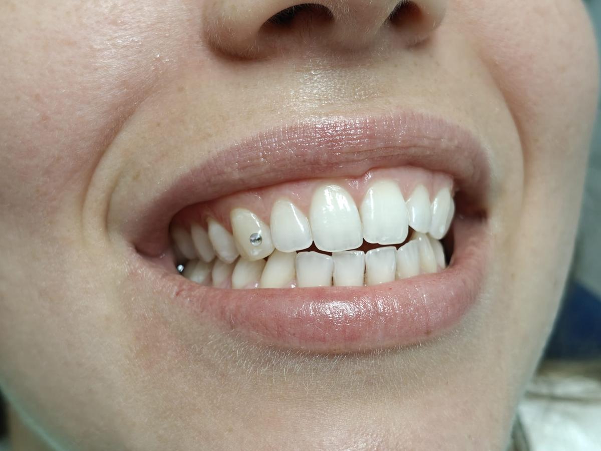 Applicazione brillantino dentale