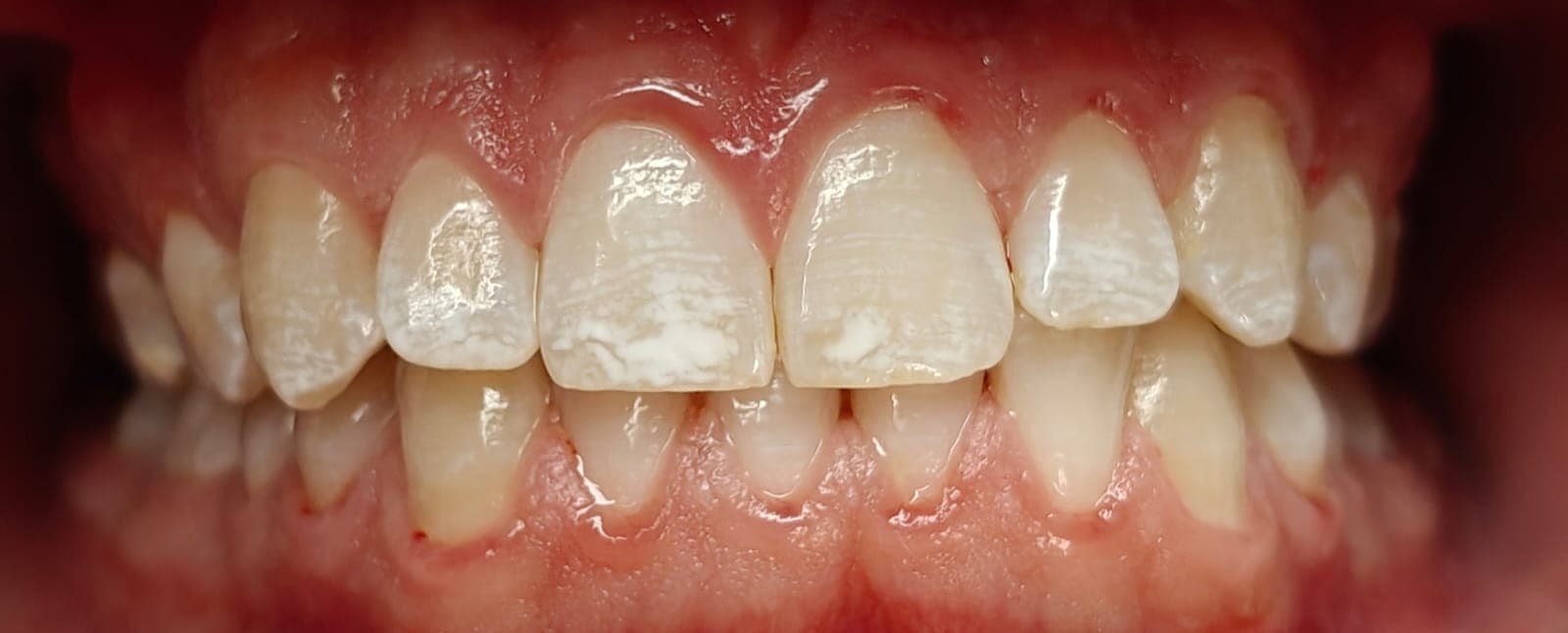 Trattamento discromie dello smalto